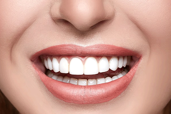 1----hollywood-smile