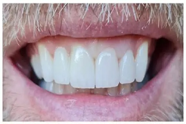 10----hollywood-smile