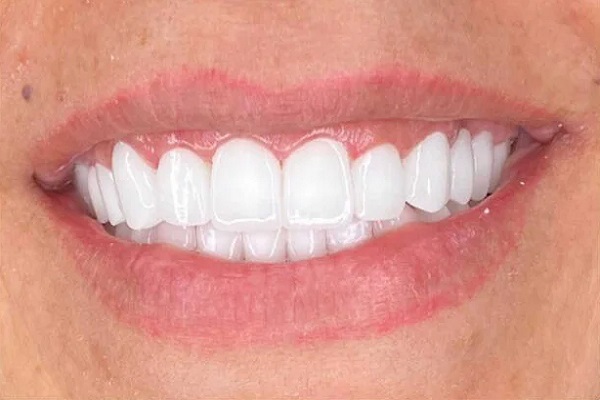 11----hollywood-smile