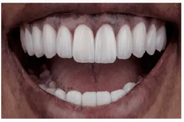 13----hollywood-smile