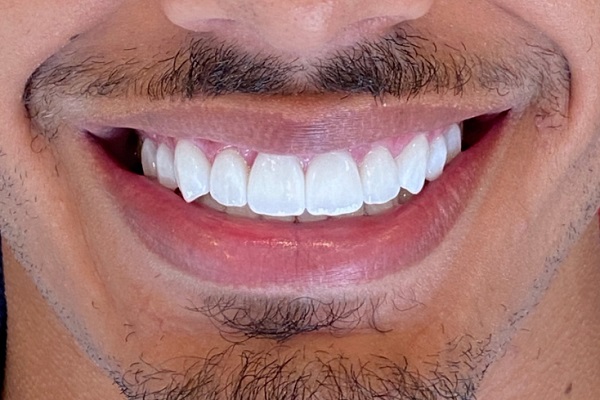 14----hollywood-smile