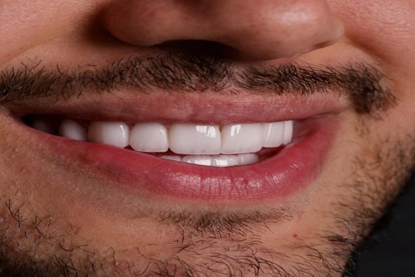 9----hollywood-smile